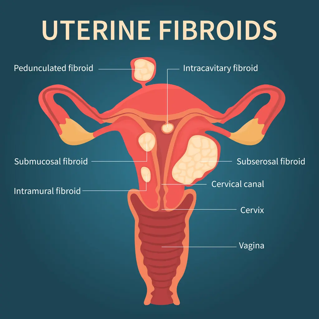 Uterine Fibroids Diagram